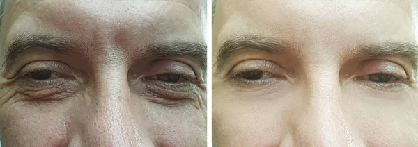 Rugas Nos Olhos Masculinos Antes Após Tratamento — Fotografia de Stock