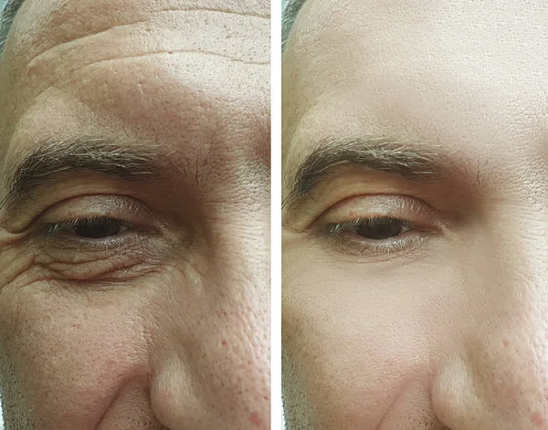 Rugas Nos Olhos Masculinos Antes Após Tratamento — Fotografia de Stock