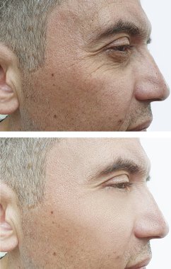 Erkek gözleri önce ve tedavi sonrası kırışıklıkları