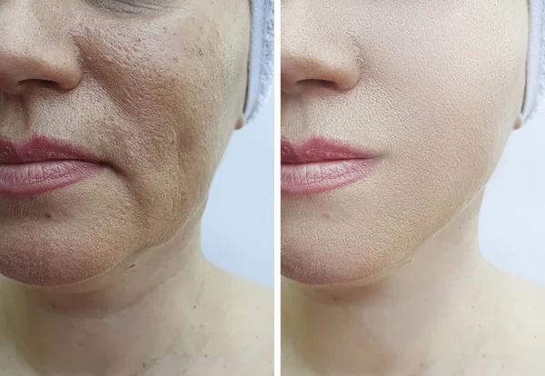 Arrugas Faciales Mujer Antes Después Del Tratamiento — Foto de Stock