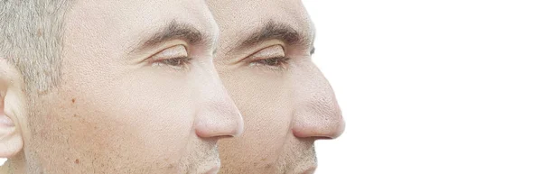 Man Nose Hump Treatment — Stock Photo, Image