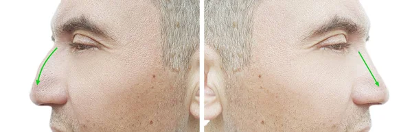 Человек Горб Носа После Лечения — стоковое фото