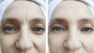 Kadın tedaviden önce ve sonra kırışıklıklarla karşılaşır