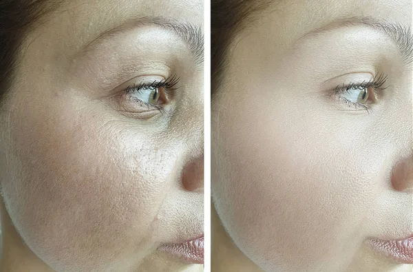 Rugas Nos Olhos Femininos Antes Depois Correção — Fotografia de Stock