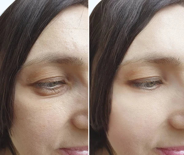 kadın kırışıklıkları yüz işlemden önce ve sonra