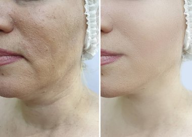 kadın kırışıklıkları yüz işlemden önce ve sonra