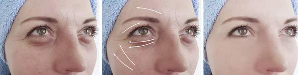 Arrugas Mujer Cara Antes Después Del Tratamiento — Foto de Stock