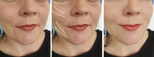 Kadın Kırışıklıkları Yüz Işlemden Önce Sonra — Stok fotoğraf