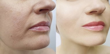 Kadın tedaviden önce ve sonra kırışıklıklarla karşılaşır