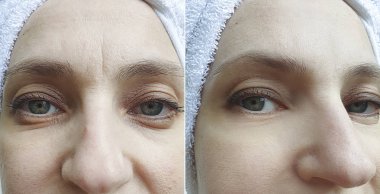 Kadın tedaviden önce ve sonra kırışıklıklarla karşılaşır