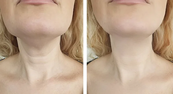 Frauenfalten Gesicht Vor Und Nach Der Behandlung — Stockfoto
