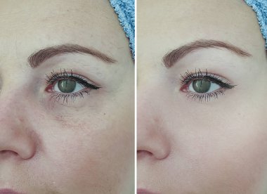 kadın kırışıklıkları yüz işlemden önce ve sonra