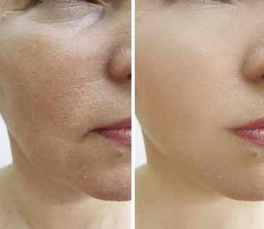 Kadın tedaviden önce ve sonra kırışıklıklarla karşılaşır