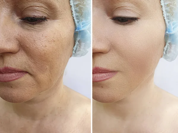 Woman Face Wrinkles Treatment — Stock Photo, Image