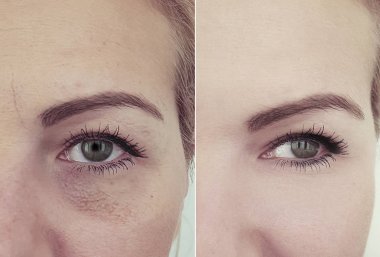 kadın yüz kırışıklıklar önce ve sonra düzeltme