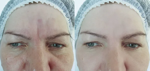 Wanita Keriput Wajah Sebelum Dan Sesudah Pengobatan — Stok Foto