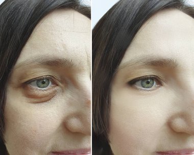 tedavi öncesi ve sonrası kadın göz kırışıklıkları