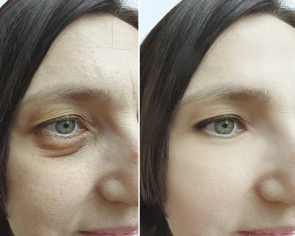 tedavi öncesi ve sonrası kadın göz kırışıklıkları