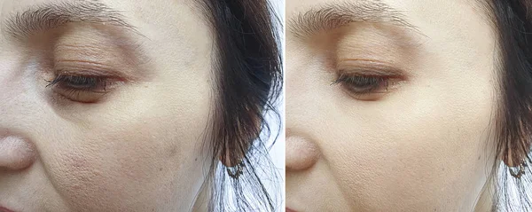 Weibliche Augenfalten Vor Und Nach Der Behandlung — Stockfoto