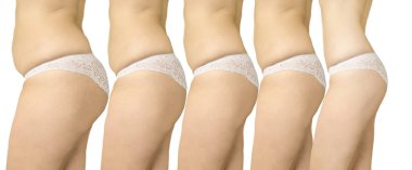 kadın aşırı kilolu selülit önce ve sonra bir diyet