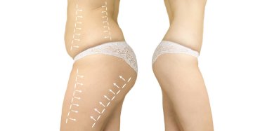 kadın aşırı kilolu selülit önce ve sonra bir diyet