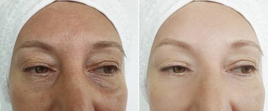 tedavi öncesi ve sonrası yaşlı kadın kırışıklıkları yüz