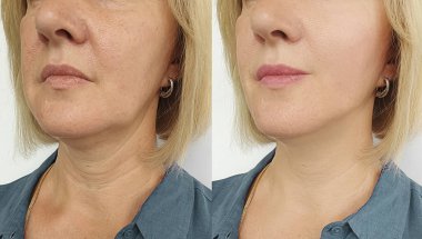 Kadın tedaviden önce ve sonra kırışıklıklarla karşılaşır