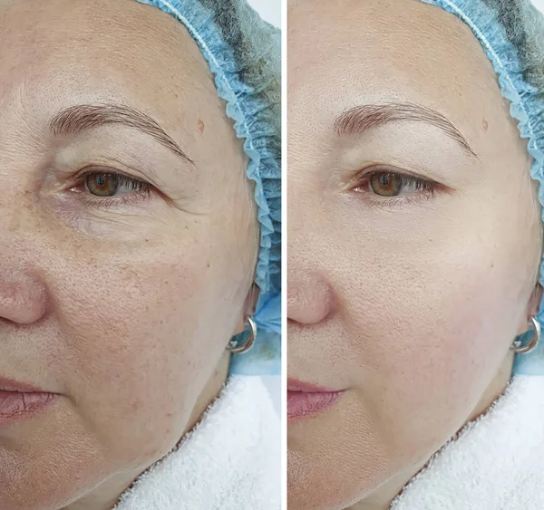 Woman Wrinkles Face Treatment — Stock Photo, Image