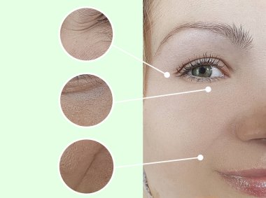 Kadın tedaviden önce ve sonra kırışıklıklarla karşılaşır