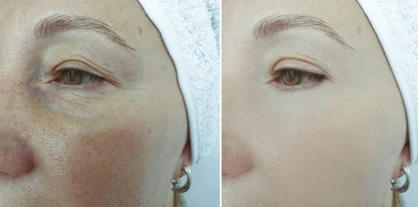 Ojos Mujer Arrugas Antes Después Del Tratamiento —  Fotos de Stock