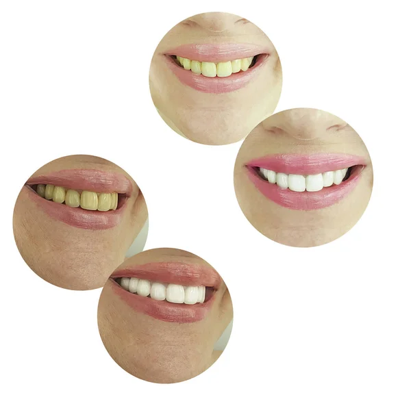 Woman Teeth Whitening — Stock Photo, Image