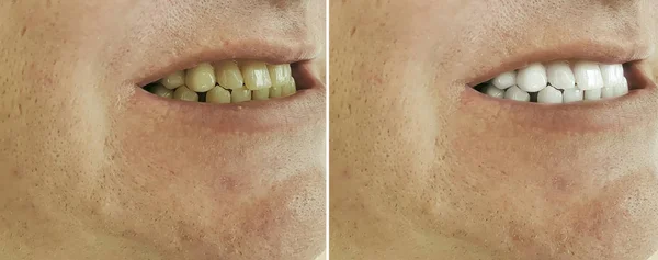 Beyazlatma Öncesi Sonrası Erkek Dişleri — Stok fotoğraf
