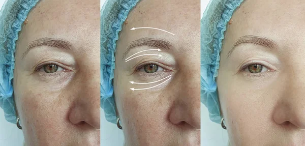 Γριά Γυναίκα Ρυτίδες Μάτια Πριν Και Μετά Θεραπεία — Φωτογραφία Αρχείου