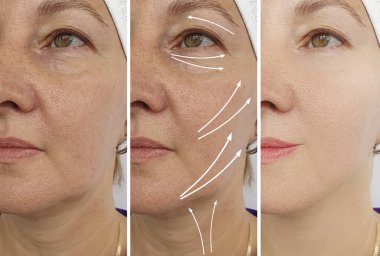 yaşlı kadın tedavi öncesi ve sonrası gözleri kırışır