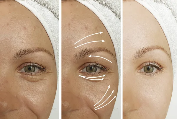 Woman Wrinkles Eyes Treatment — Stock Photo, Image