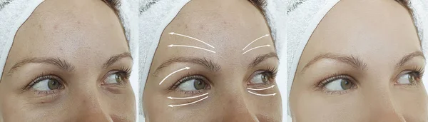 Mulher Rugas Olhos Antes Após Tratamento — Fotografia de Stock