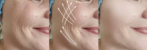 Arrugas Cara Mujer Antes Después Del Tratamiento —  Fotos de Stock