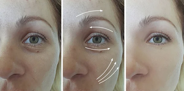 Vrouw Facial Rimpels Voor Behandeling — Stockfoto