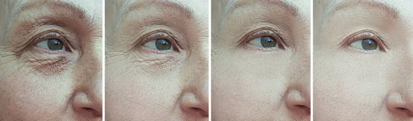 Mulher Idosa Rugas Olhos Antes Após Tratamento — Fotografia de Stock