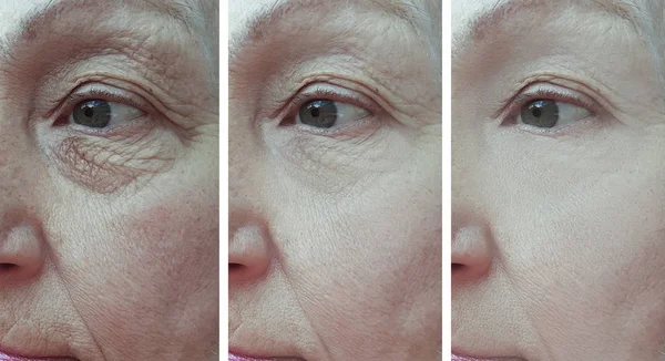 Ηλικιωμένη Γυναίκα Ρυτίδες Μάτια Πριν Και Μετά Θεραπεία — Φωτογραφία Αρχείου