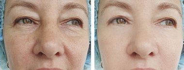 Kadın tedaviden önce ve sonra kırışıklıklarla karşılaşır