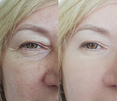 Yaşlı kadın tedavi öncesi ve sonrası göz kırışıklıkları