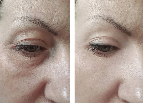 Ojos Mujer Arrugas Antes Después Del Tratamiento — Foto de Stock