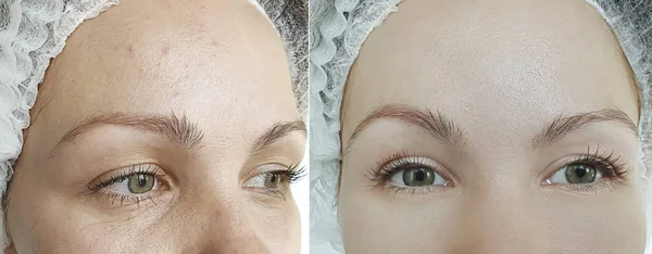 Kadın Gözü Tedaviden Önce Sonra Kırışıyor — Stok fotoğraf