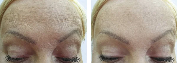 Woman Forehead Wrinkles Treatment — Stock Photo, Image