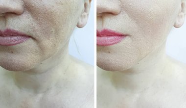 Kadın tedaviden önce ve sonra kırışıklıklarla karşılaşır