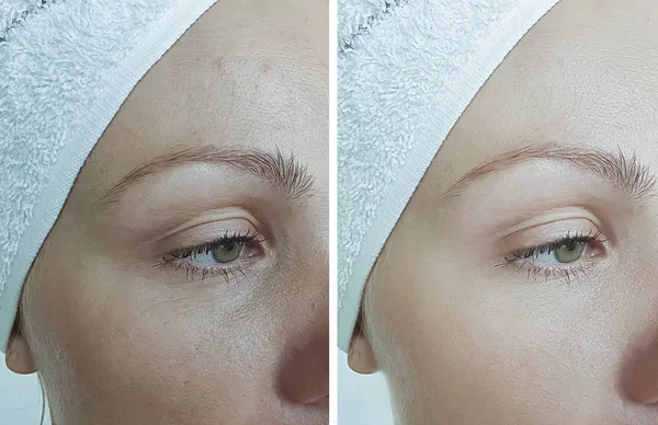 Rugas Dos Olhos Mulher Antes Após Tratamento — Fotografia de Stock