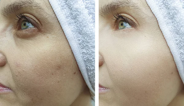 Mata Wanita Wajah Keriput Sebelum Dan Setelah Pengobatan — Stok Foto
