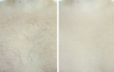 erkek göğüs kılı tüy dökümünden önce ve sonra