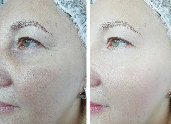 Arrugas Mujer Anciana Antes Después Del Tratamiento —  Fotos de Stock